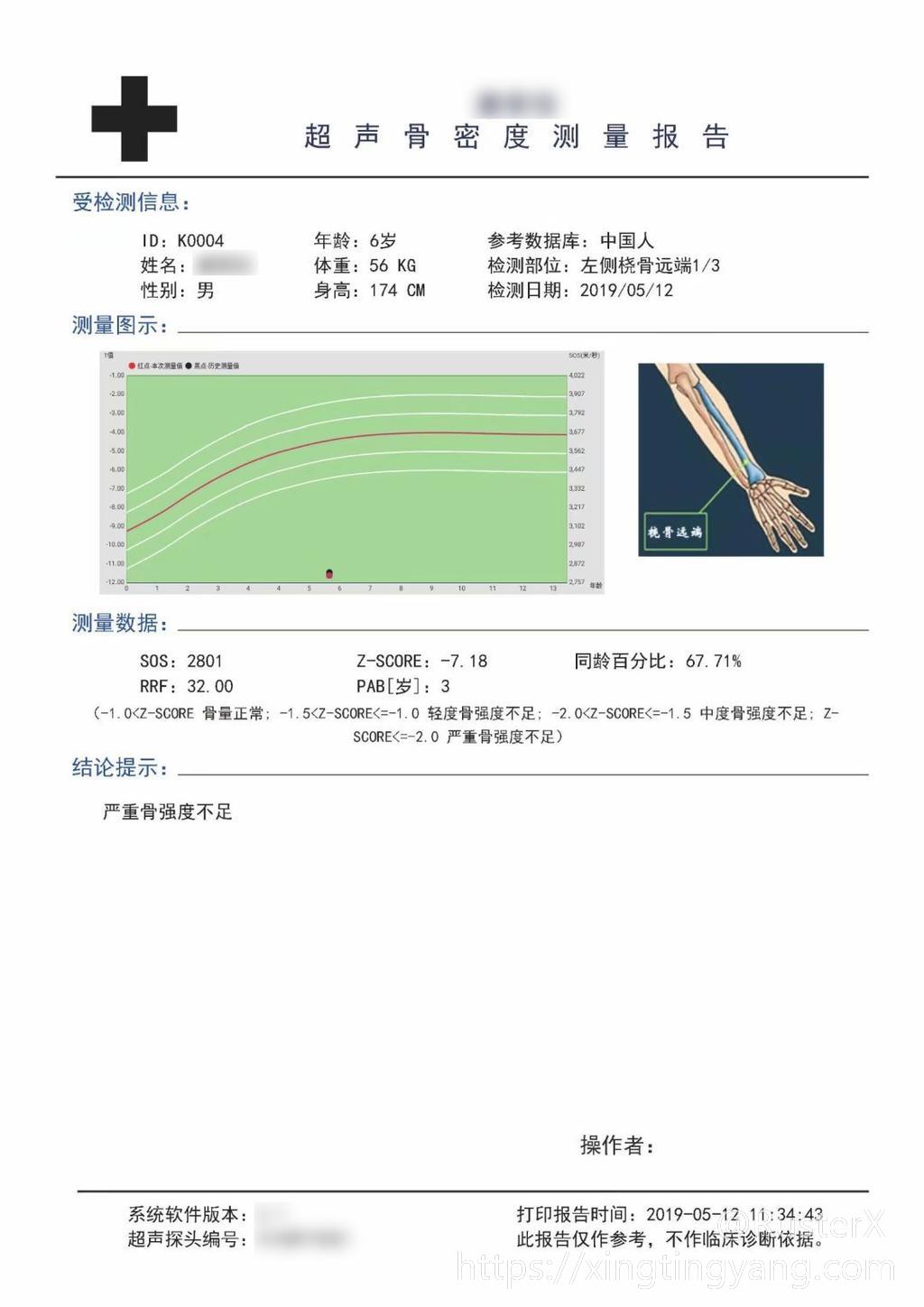 骨密度测量仪